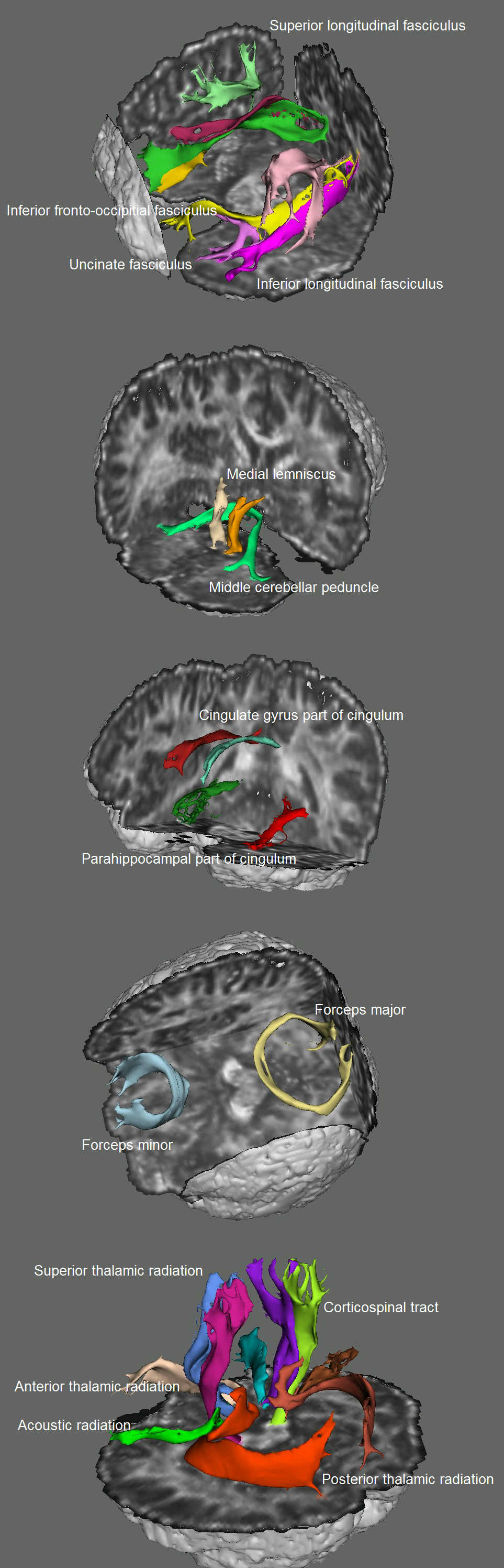 white matter tracts